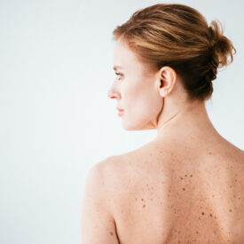 Prévention du cancer de la peau et protection contre les UV